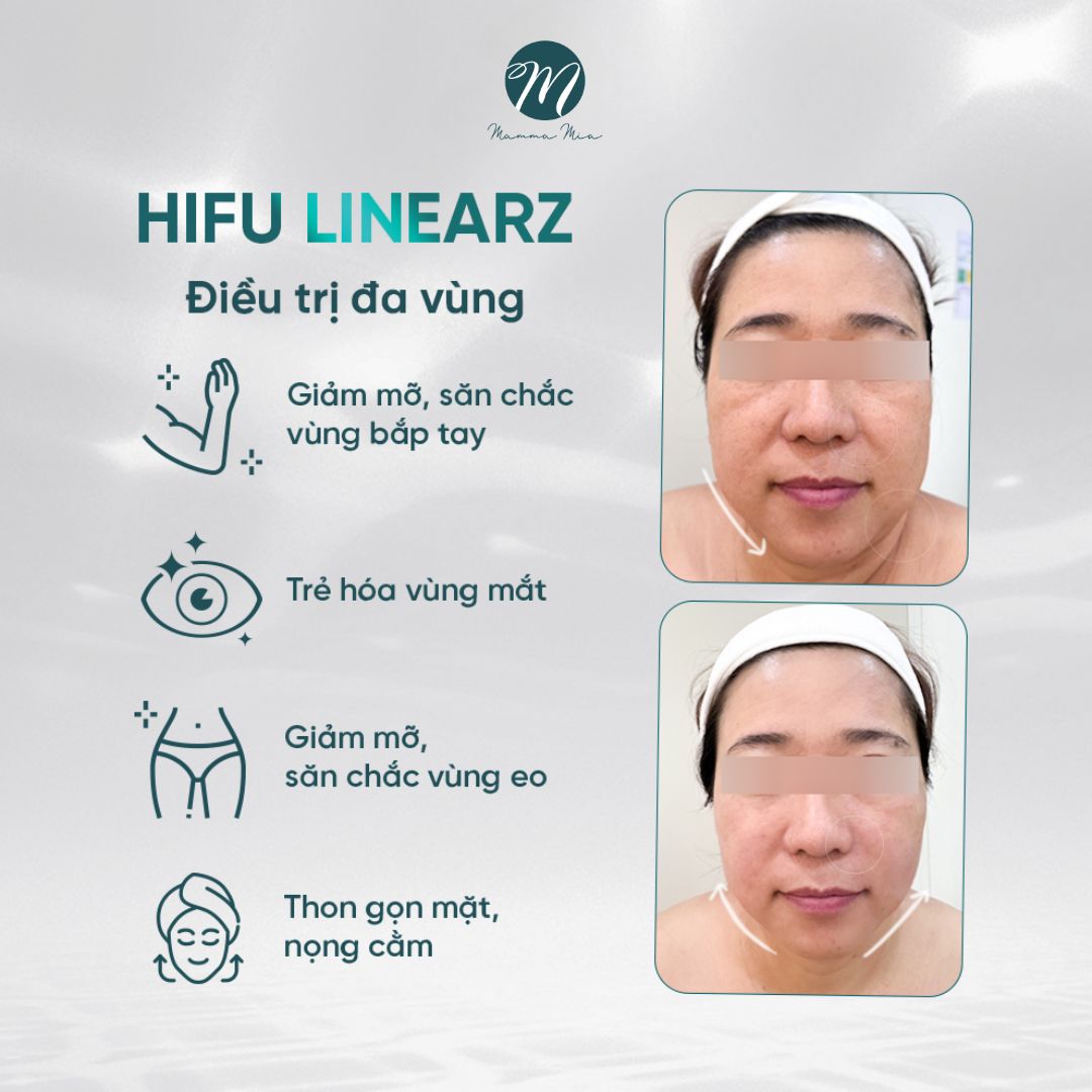 hifu-linearz-nang-co