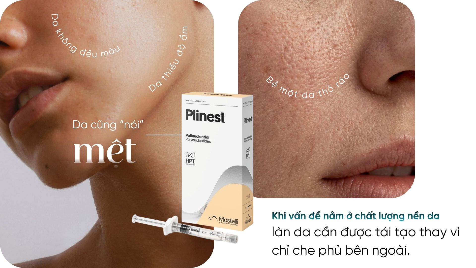 Plinest 1